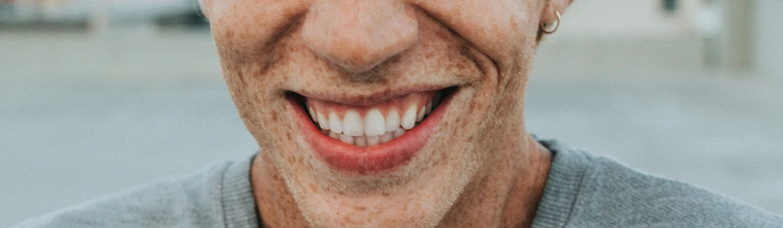 Dentist Flower Mound TX Crowns Focused A close-up shot captures a person's joyful smile, revealing bright white teeth and their freckled skin.